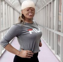 Salteña se quemó casi el 90% de su cuerpo cuando era bebé y hoy es un ejemplo de superación